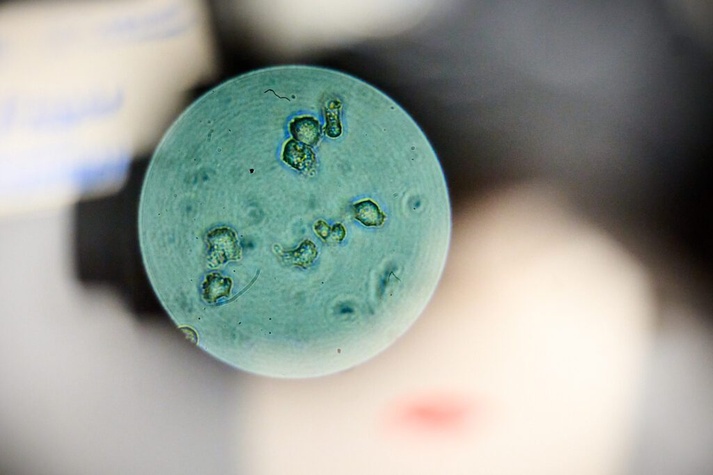 a Petri dish of the amoeba that causes a sight-threatening eye infection. Eighty-five percent of people who get it are contact lens wearers.